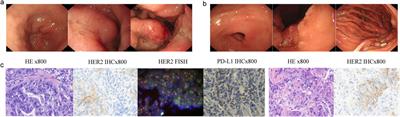 The addition of PD-1 inhibitor overcame trastuzumab resistance in patients with HER2 positive, PD-L1 negative metastatic gastric cancer: Case report and review of literature